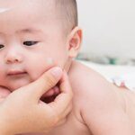 cách chữa chàm sữa cho trẻ sơ sinh