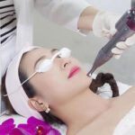 có nên trị nám bằng laser không
